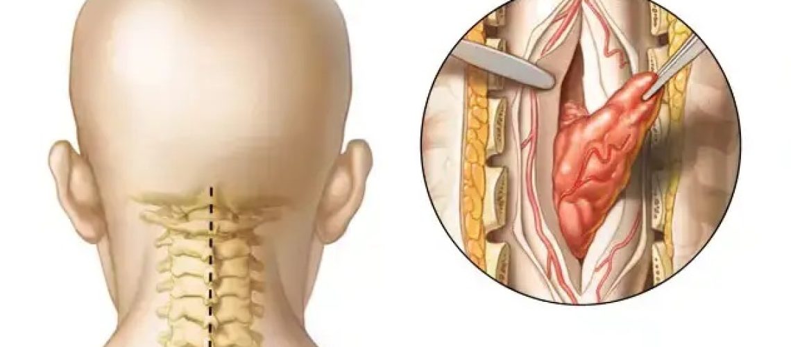 تومور از گردن