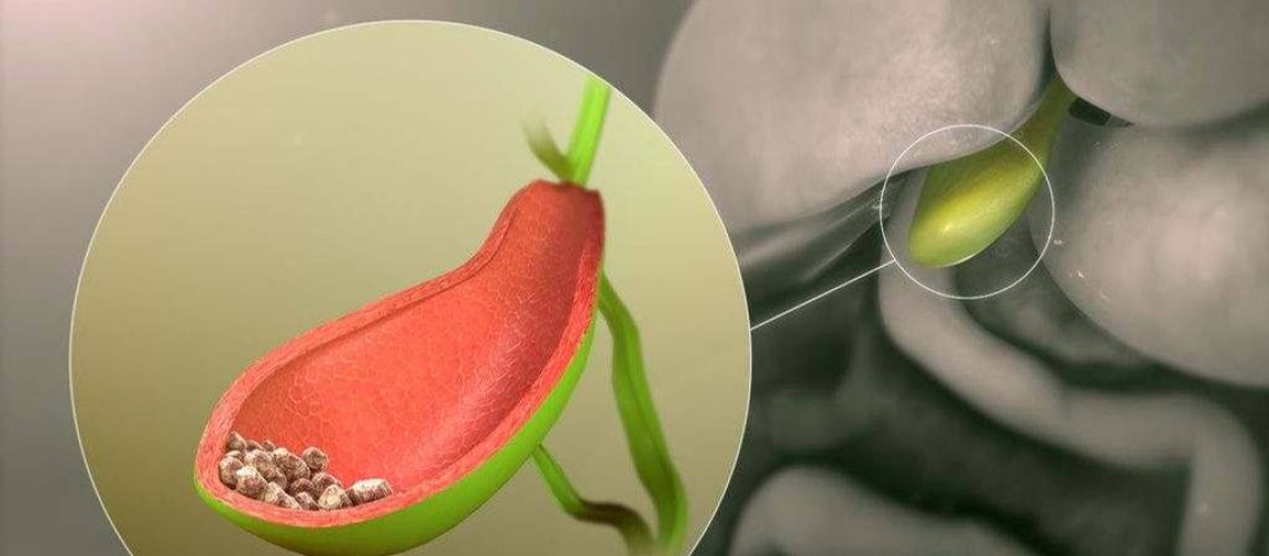 پولیپ کیسه صفرا